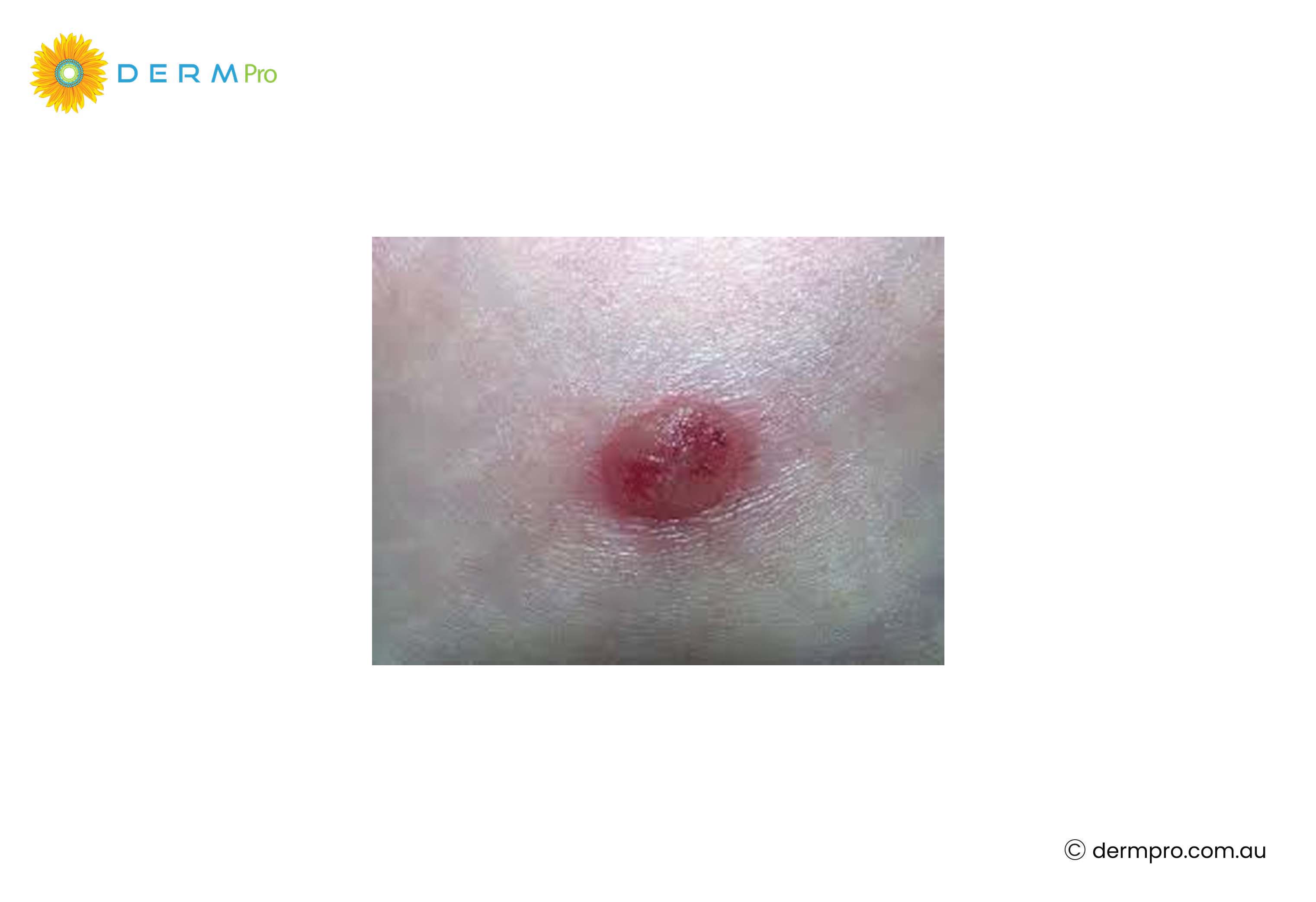 Seborrheic Keratoses images